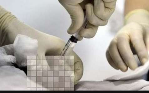  无精症患者想生子可用显微取精